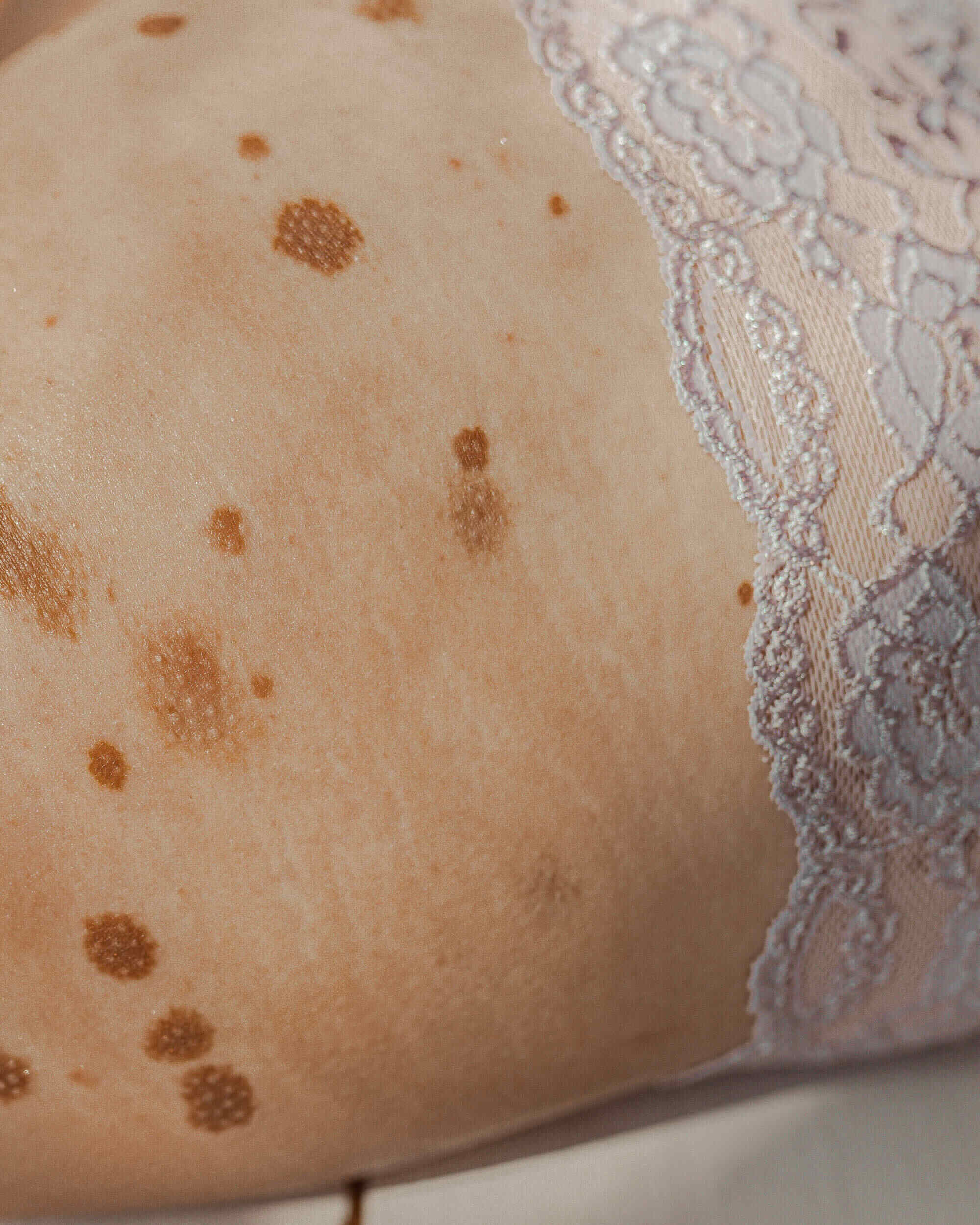 En närbild av en persons hud som visar mörka fläckar