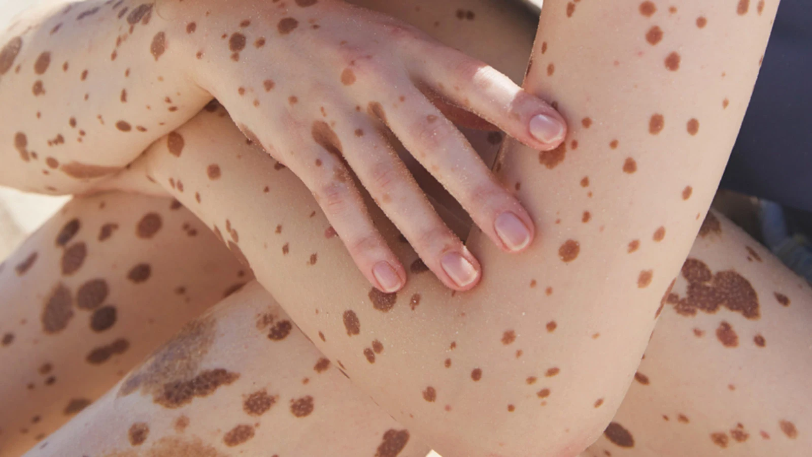 Kvinna med fräknar hud som rör vid hennes armar