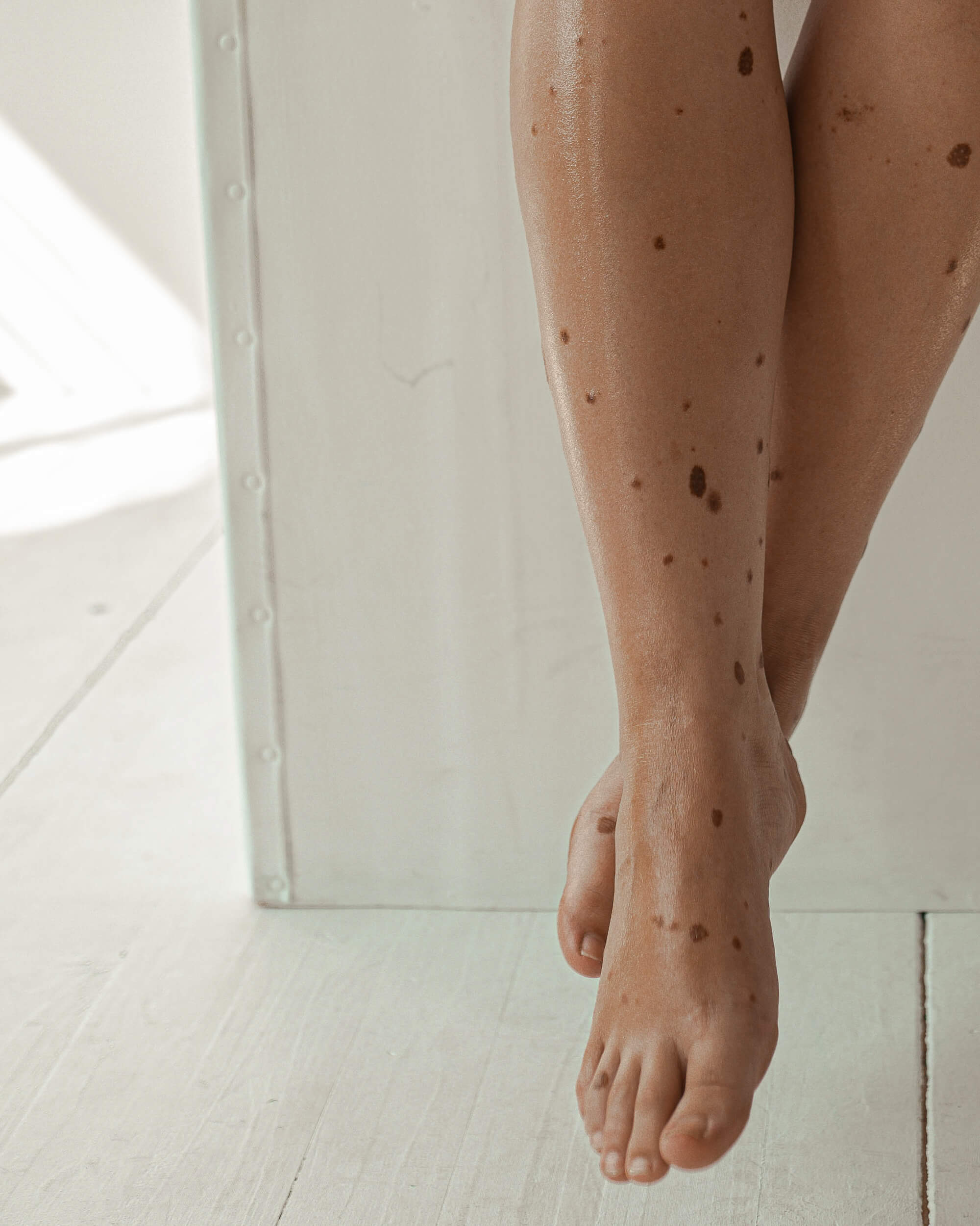 En närbild av en persons ben som visar mörka hudfläckar
