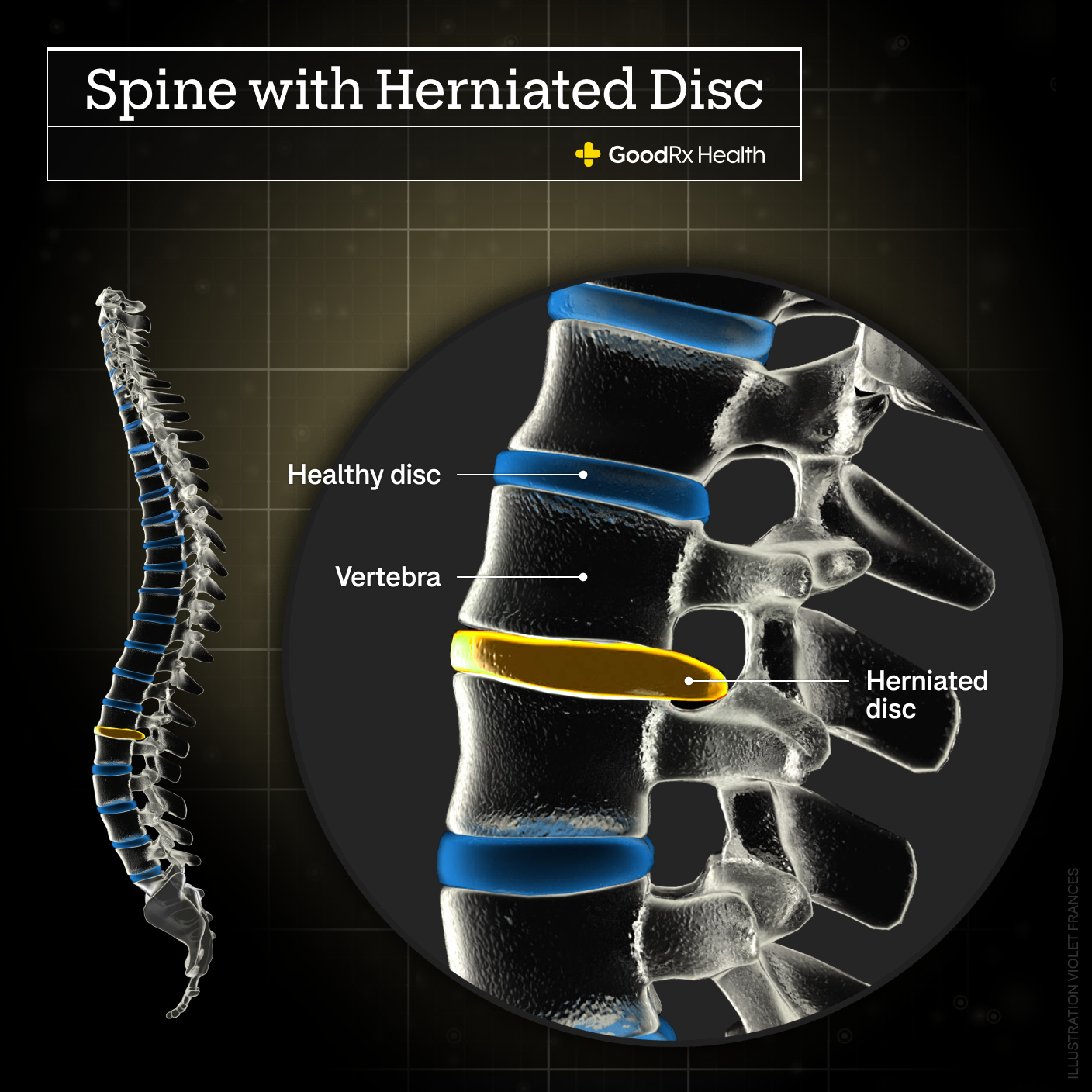 A 3D illustration of a spine with a herniated disc including healthy disc, vertebra, and herniated disc.