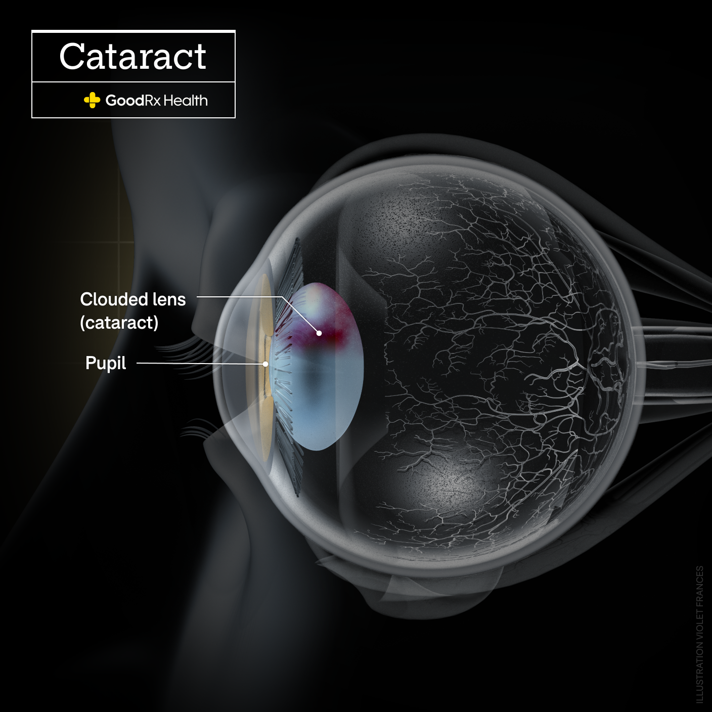 A 3D illustration of a cataract highlighting the pupil and clouded lens (cataract).