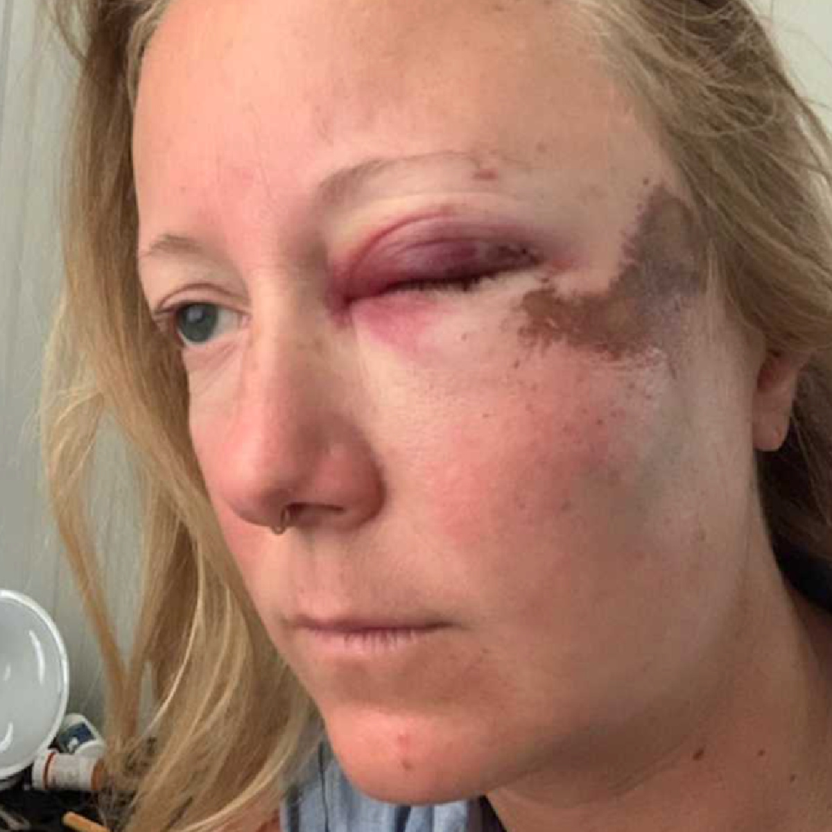 Sharon Eriksen is pictured with facial injuries from her biking accident.