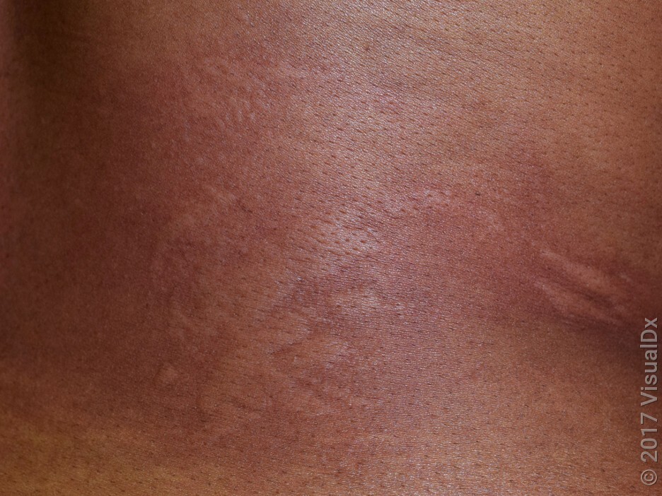 Hives in darker skin may be harder to see.