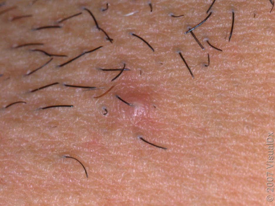 Close-up image of an ingrown hair bump and some trapped hairs.