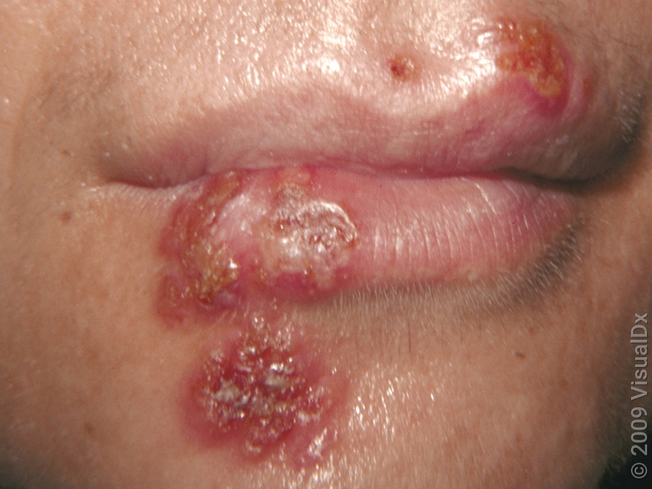 Close-up of the lips with a crusty fever blister.
