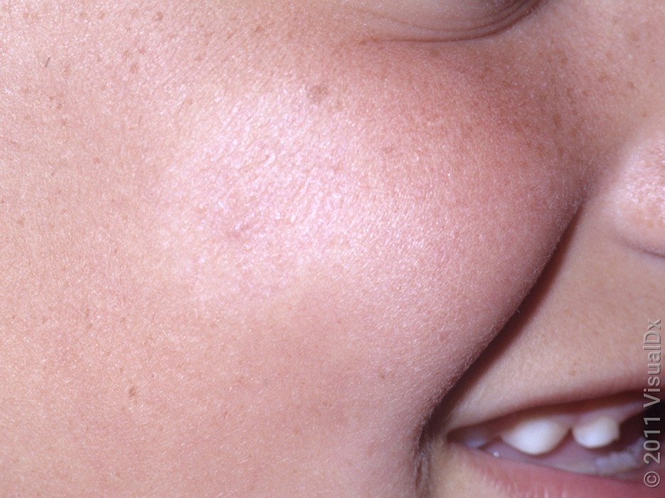 Close-up of the cheek with a faint light patch.