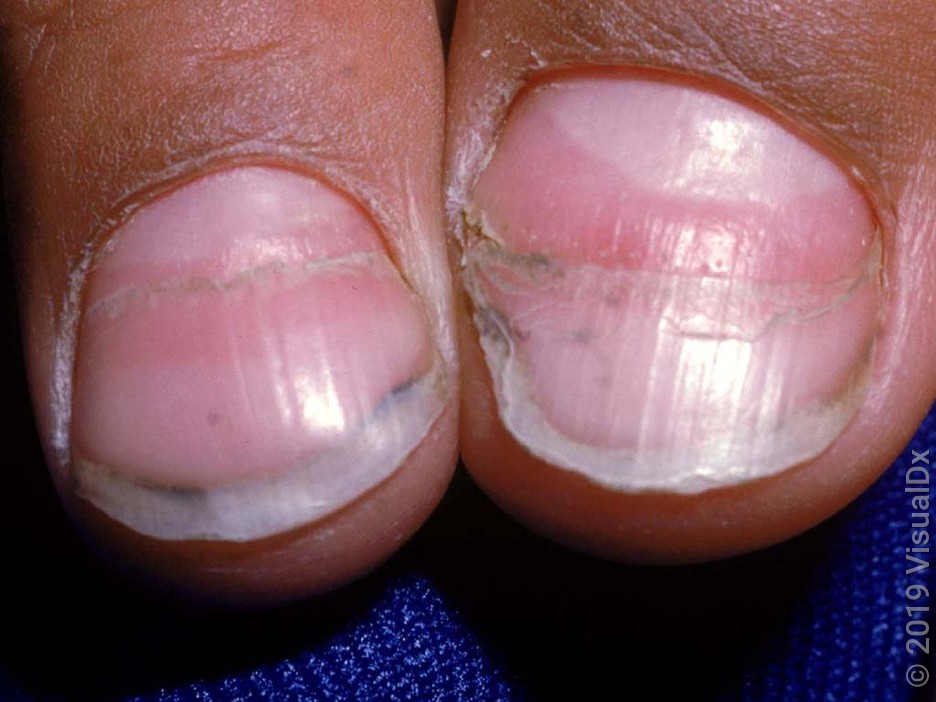 Close up of nails with a horizontal ridge (Beau’s lines).