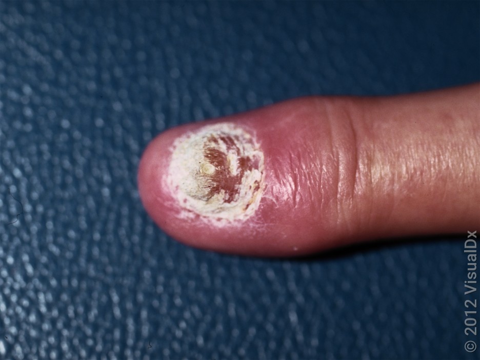 Close-up of a nail that looks crumbly (nail psoriasis).