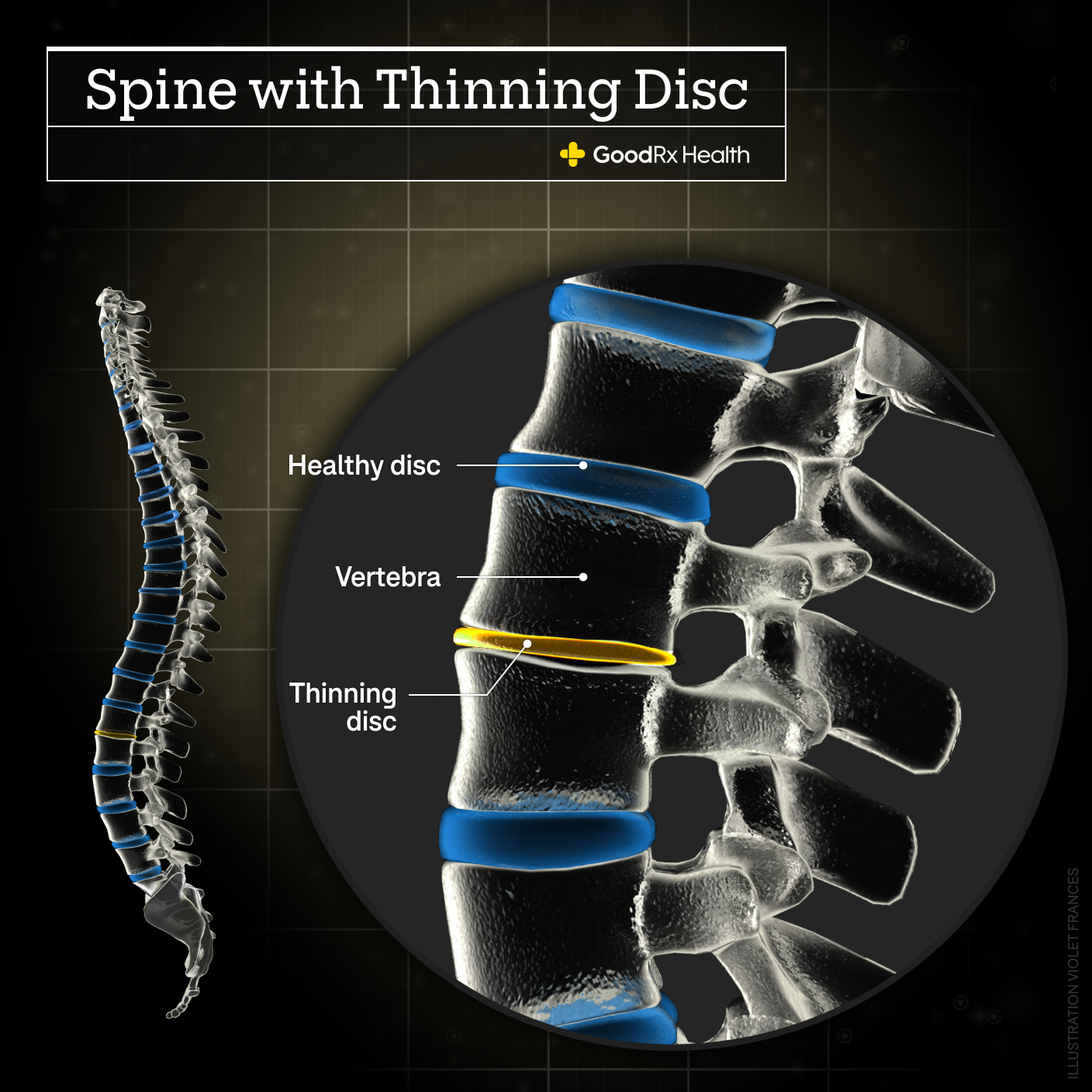 A 3D illustration of a spine with a thinning disc including healthy disc, vertebra, and thinning disc.
