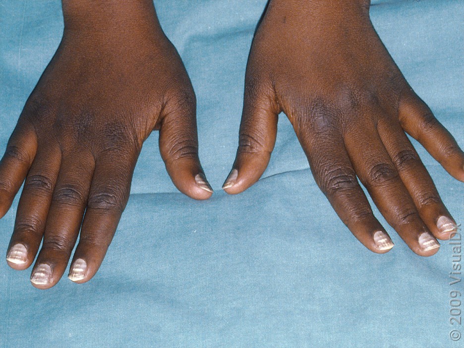 White horizontal lines across all the fingernails.