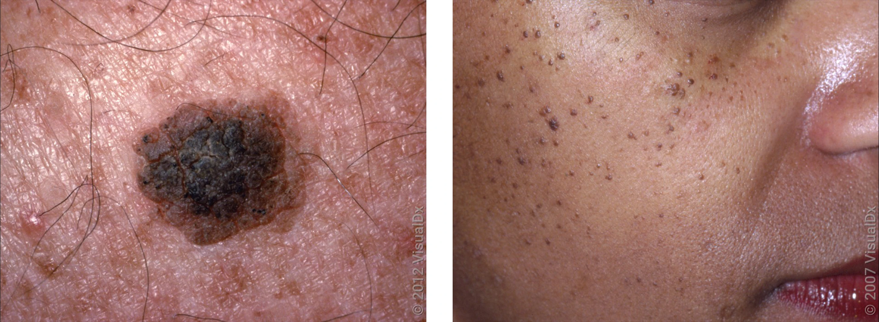 Left: Close-up picture of a large, round, rough skin bump. Right: May small tan and brown skin bumps on the cheek.