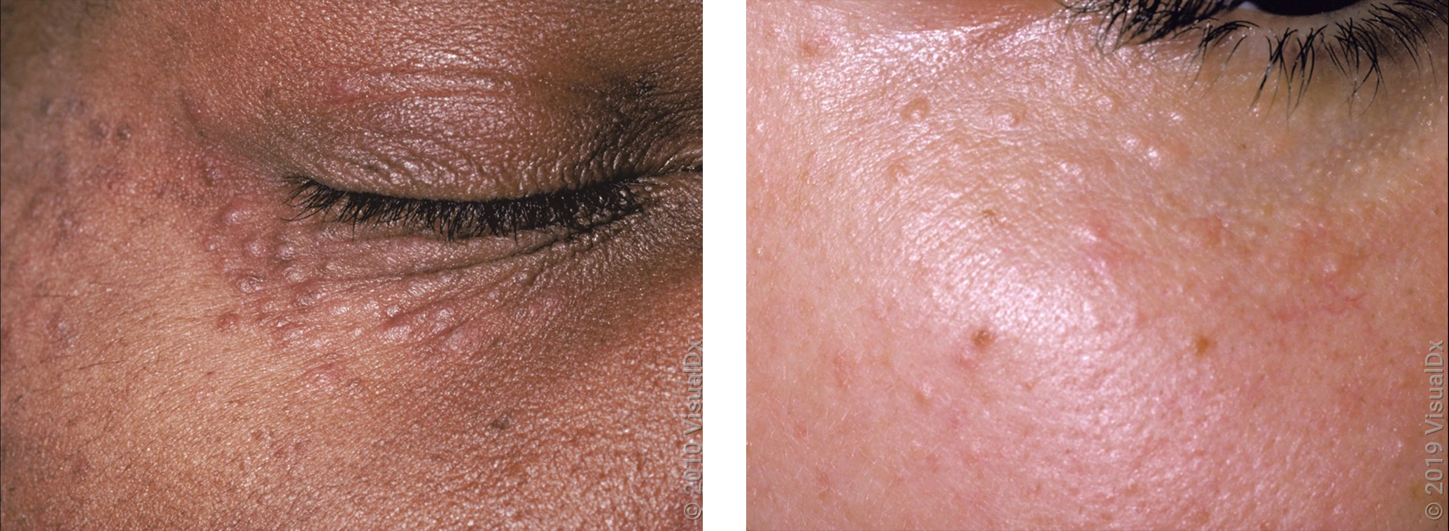 Left: Many small, flat brown bumps on the skin around the outside of the eye. Right: Many small, flat tan bumps on the cheek beneath the eye.