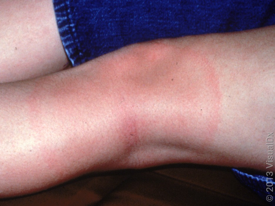 Pink or red circles around a tick bite site in Lyme disease.