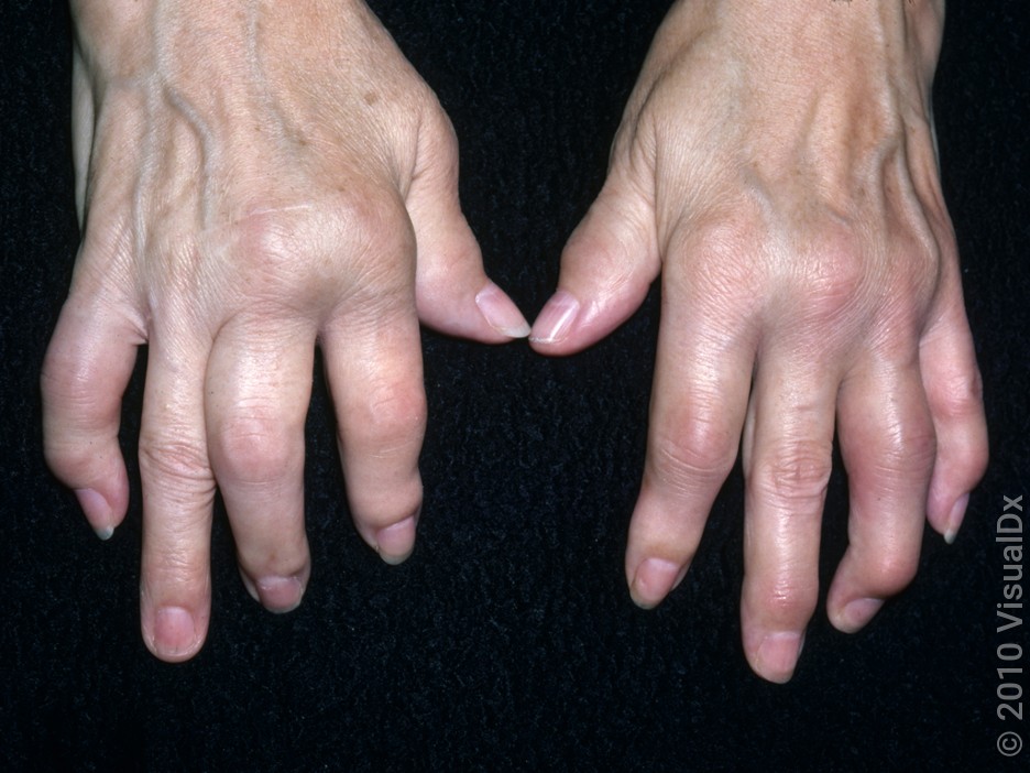 Joint swelling on the hands in psoriatic arthritis.