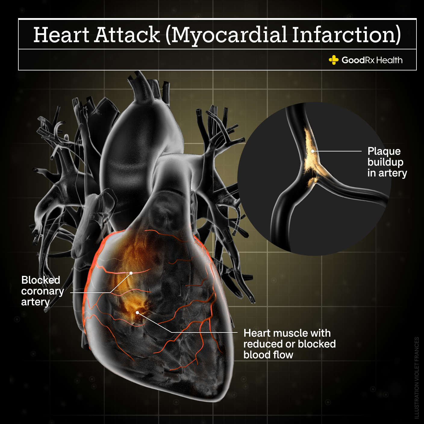 A 3D illustration of a heart attack including plaque buildup in artery, blocked coronary artery, and heart muscle with reduced or blocked blood flow.