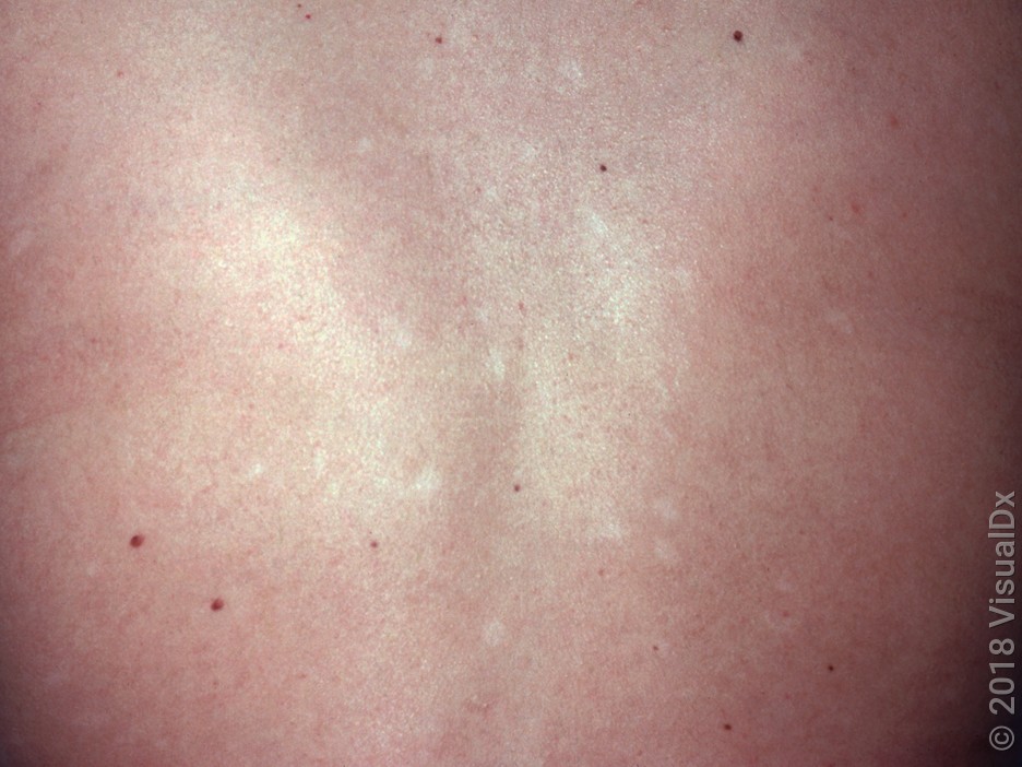 Close-up of the back with post-inflammatory hypopigmentation.