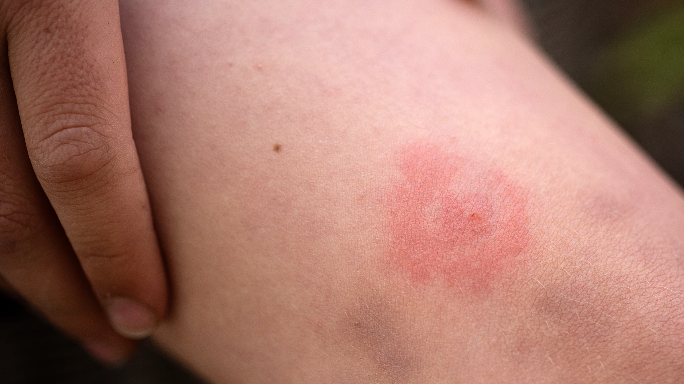 Close-up tick bite in the region of a child's knee.