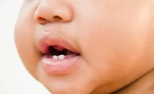Cómo prevenir la caries infantil  article link
