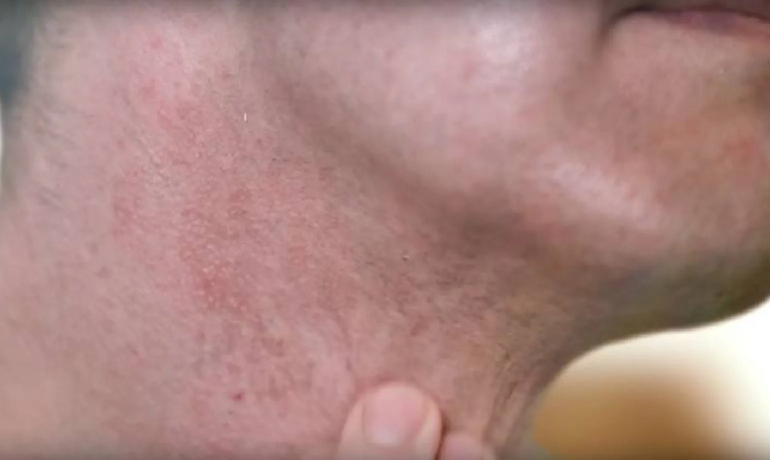 Rasieren verursacht Hautirritationen und Unbehagen