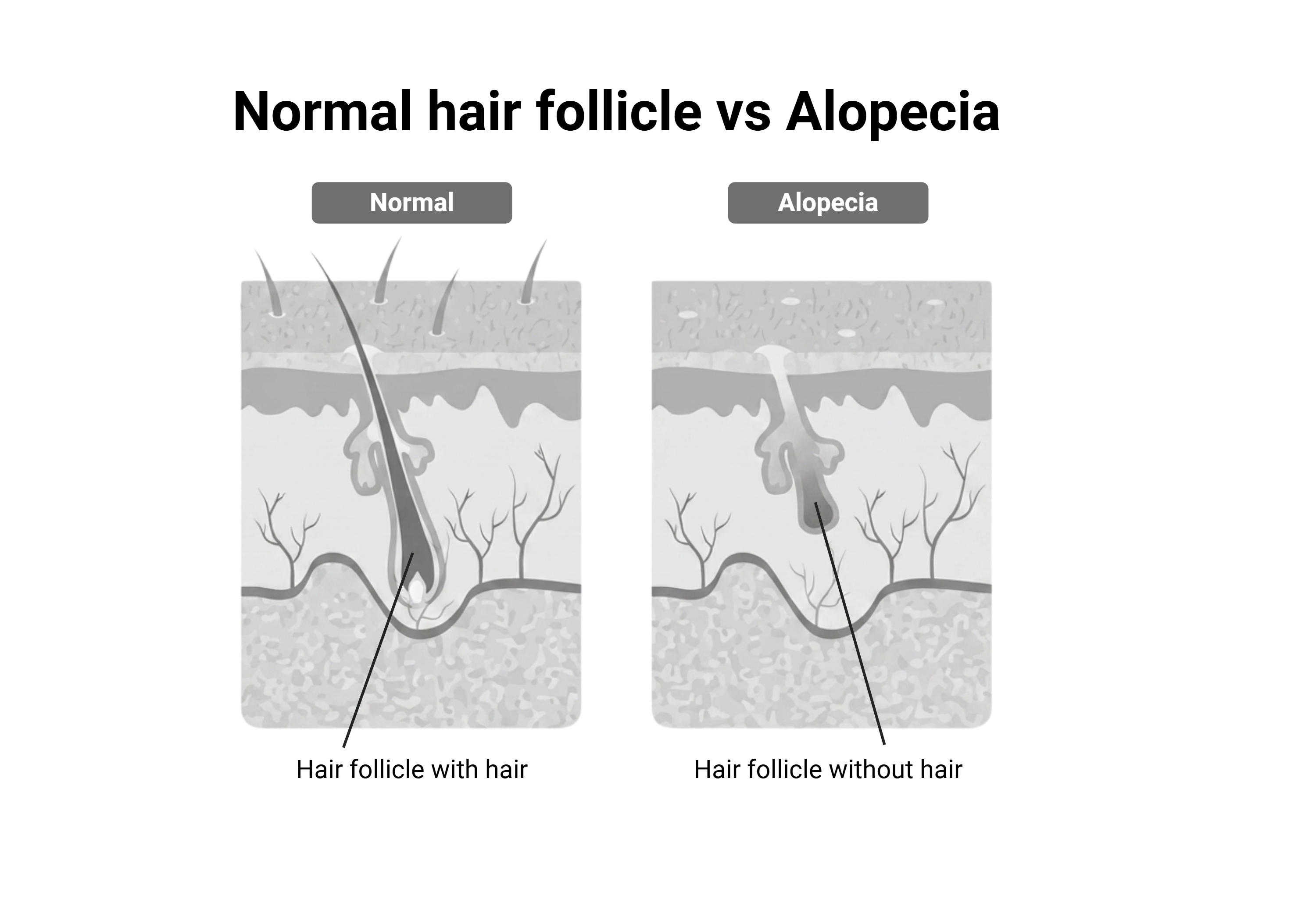 8543 Alopecia
