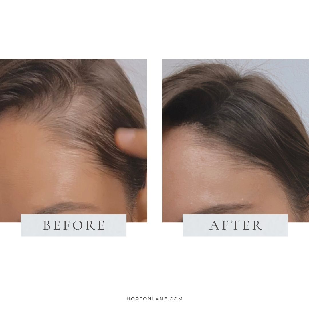 Motherhood-Postpartum hair loss regrowth toppik hair powder before and after