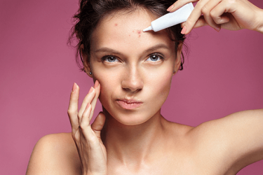 Uma rapariga determinada com a acne visível na testa aplica pontualmente um produto para eliminar borbulhas