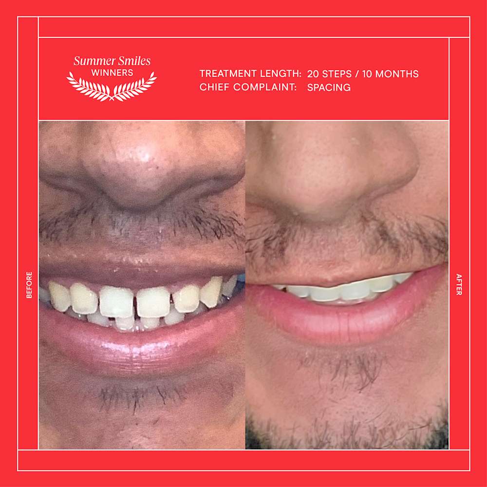 Pablo-teeth-transformation