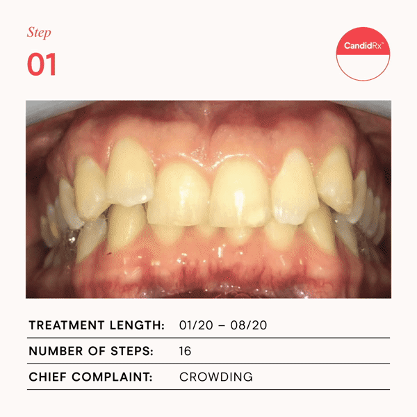 Crowding Case 1