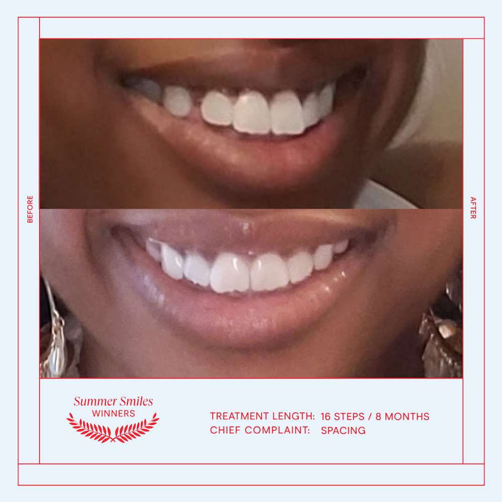 Shavelle before and after