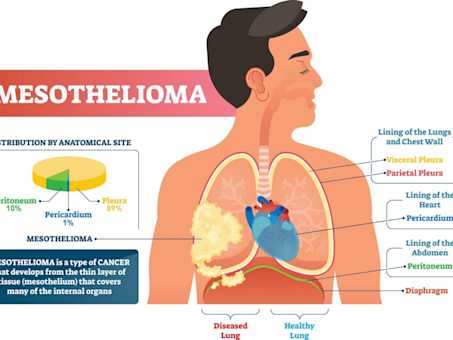 Mesothelioma