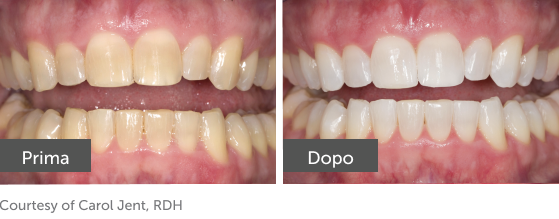 pf before/after
