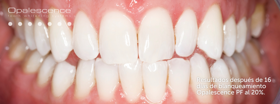 Después de Blanqueamiento Dental Opalescence