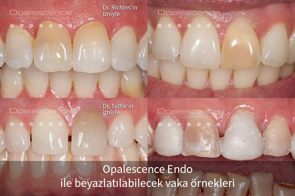 Dental Crown versus Dental Veneer
