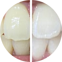 Before/After using Opalescence™ Boost™