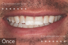 Before using Opalescence Endo