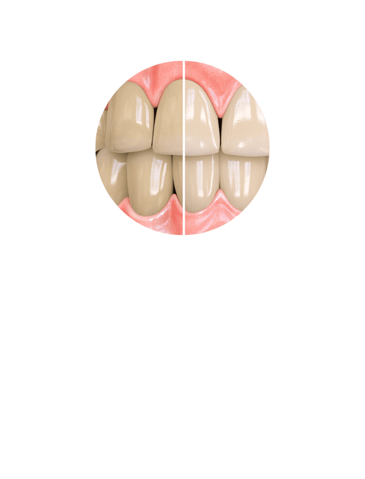 Opalescence Zahncreme – Modell