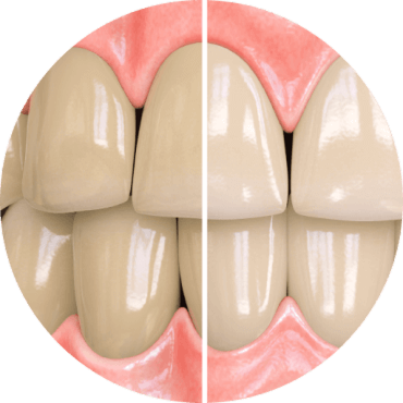 Opalescence Toothpaste Model