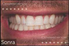 After using Opalescence Endo