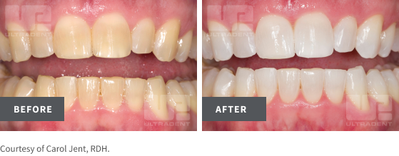 pf before/after