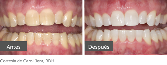 pf before/after