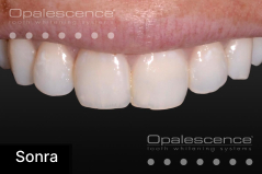 After using Opalescence Endo