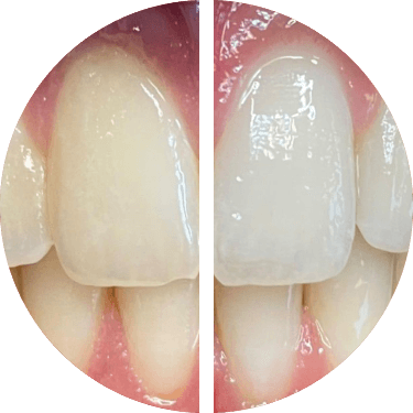 Before/After using Opalescence Go™