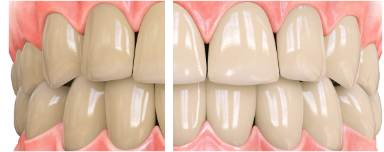 opalescence before/after