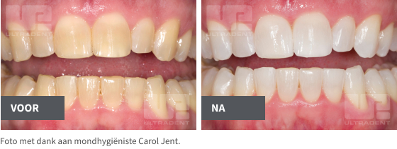 pf before/after