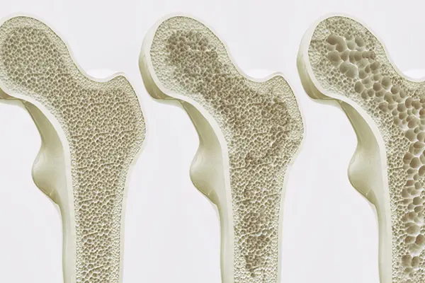 A graphic of the inside of a bone going from a healthy bone to one with osteoporosis.