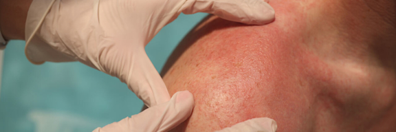 Hände mit Handschuhen untersuchen einen Hautausschlag an der Schulter.