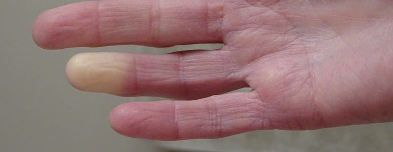 Raynaud-Syndrom: Hand mit weißer Verfärbung am Endglied des Ringfingers.