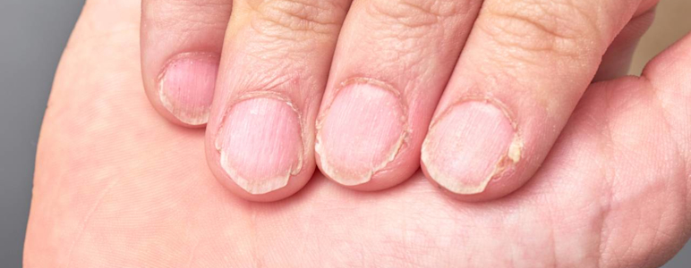 Hand mit brüchigen Fingernägeln.