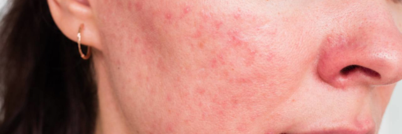 Im Gesicht einer Frau sind Hautveränderungen auf den Wangen zu sehen. Es handelt sich um Rosacea, diese chronisch-entzündliche Hauterkrankung wird auch Rosazea, Kupferrose oder Kupferfinne genannt.