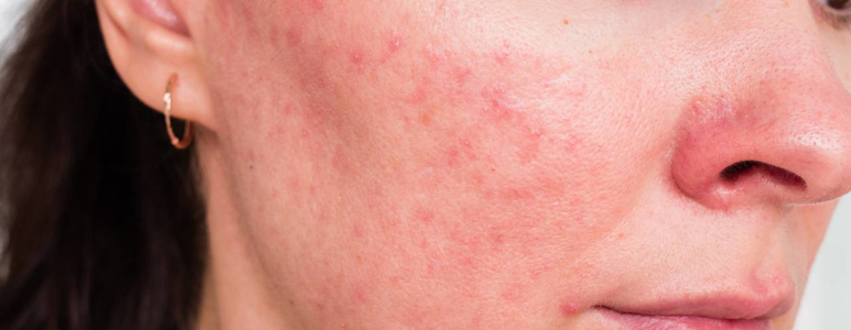 Im Gesicht einer Frau sind Hautveränderungen auf den Wangen zu sehen. Es handelt sich um Rosacea, diese chronisch-entzündliche Hauterkrankung wird auch Rosazea, Kupferrose oder Kupferfinne genannt.
